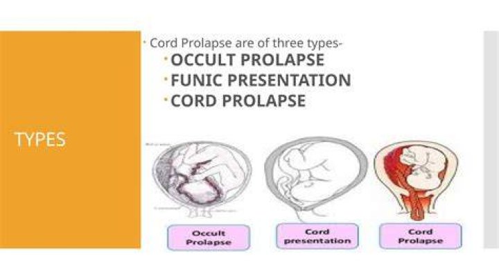 What is Funic prolapse?